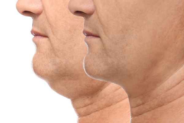 HIFU - Breakthrough in Anti - ageing 2 hifu results Stanford-le-Hope