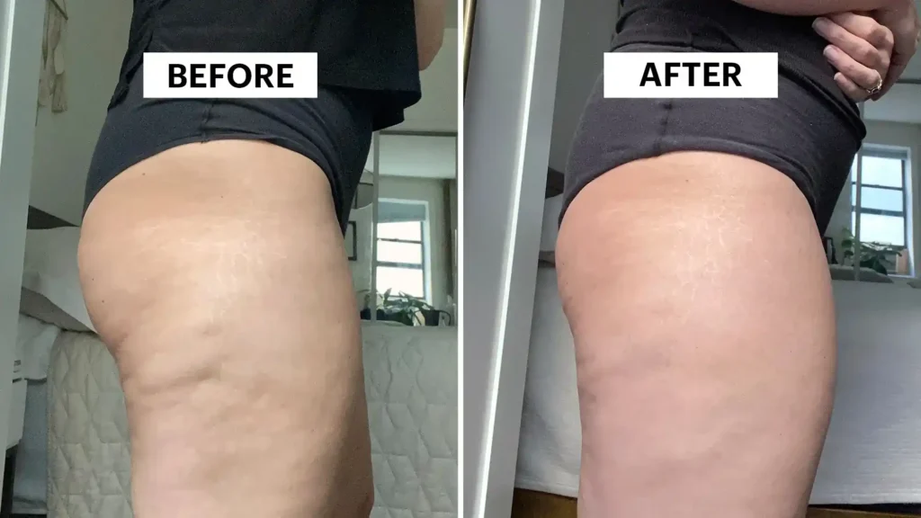 Sculpting Your Bum: Can Toning Exercises Really Reduce Cellulite? 1 Do Toning Exercise Stanford-le-Hope Really Tackle Cellulite?