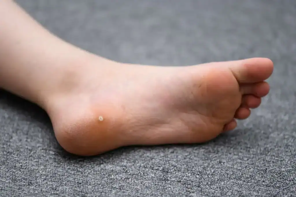 Cryotherapy For Warts And Also Verrucas 2 Image of verruca on the bottom of the foot that able to be treated with Cryotherapy Stanford-le-Hope