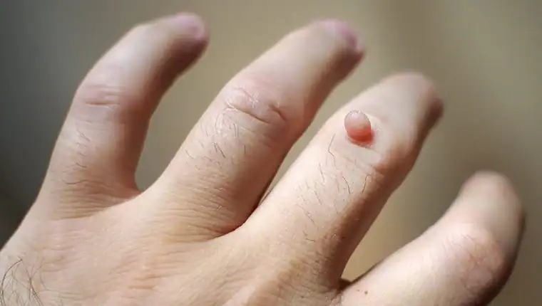 Cryotherapy For Warts And Also Verrucas 1 Image of blemish that Cryotherapy Stanford-le-Hope can remove with Lipo 360.
