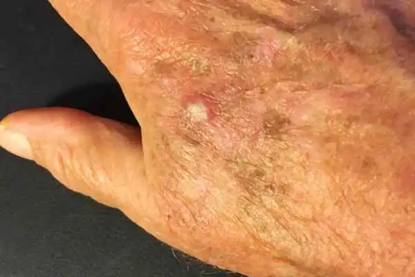 Cryopen For Actinic Keratoses 1 Image of Actinic keratoses Stanford-le-Hope on a person hand
