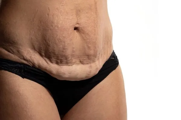 The science behind skin tightening Stanford-le-Hope picture of a woman's sagging skin on the stomach